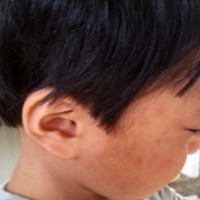 突発性発疹